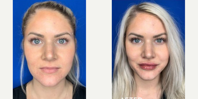 Vollure before and after photo