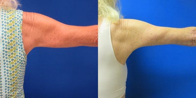 Arm Lift before and after photo