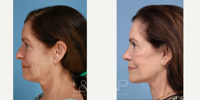 Neck Lift before and after photo