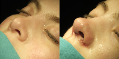 Revision Rhinoplasty before and after photo