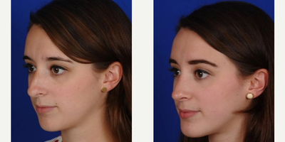 Rhinoplasty before and after photo