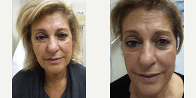ThermiSmooth Face before and after photo