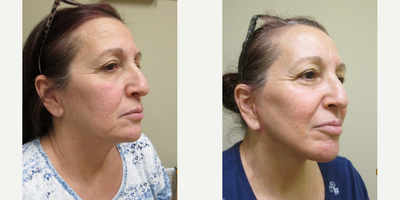 Eyelid Surgery before and after photo