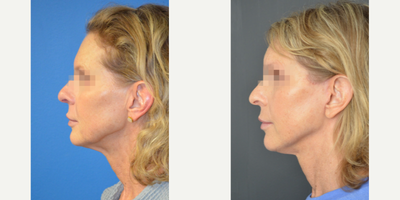 Facelift before and after photo