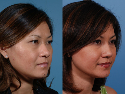 Asian Rhinoplasty before and after photo