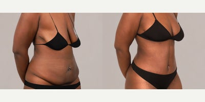 Breast Fat Transfer before and after photo