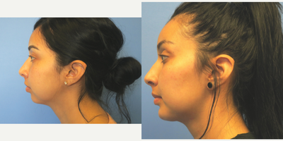 Chin Implant before and after photo