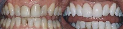 Dental Crown before and after photo