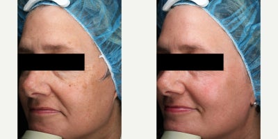 Halo Laser before and after photo