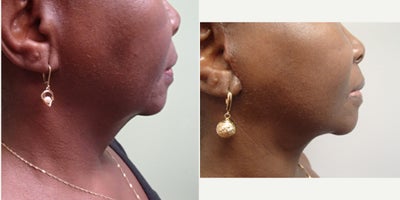 Liposuction before and after photo