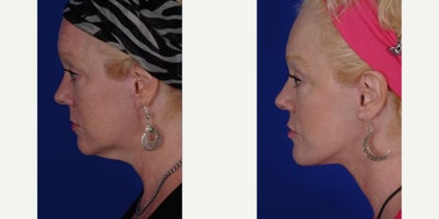 Neck Lift before and after photo