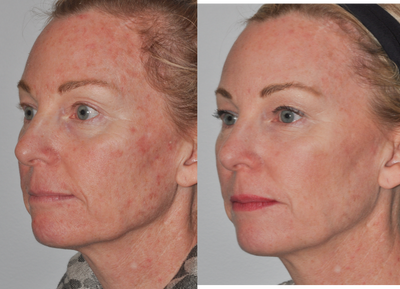 Restylane before and after photo