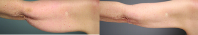 Smart Lipo before and after photo
