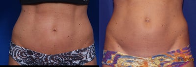 Smart Lipo before and after photo