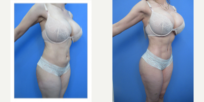 Vaser Liposuction before and after photo