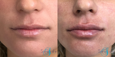 Volbella before and after photo