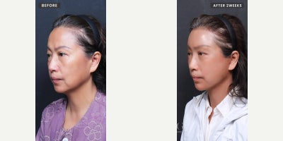 Neck Lift before and after photo
