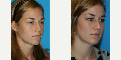 Rhinoplasty before and after photo