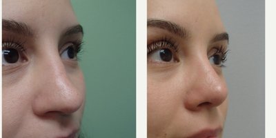 Rhinoplasty before and after photo