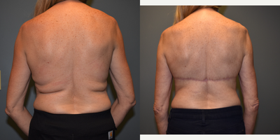 Body Lift before and after photo