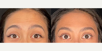 Botox before and after photo