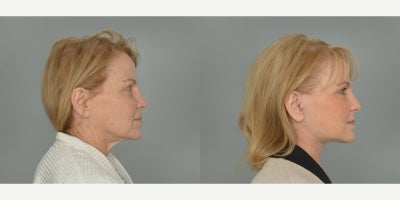 Deep Plane Facelift before and after photo