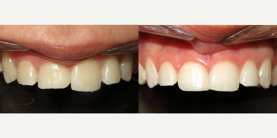 Dental Bonding before and after photo
