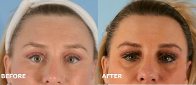 Eyelid Surgery before and after photo