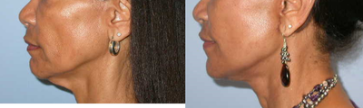 Neck Lift before and after photo