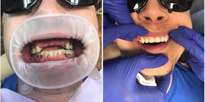 Smile Makeover before and after photo