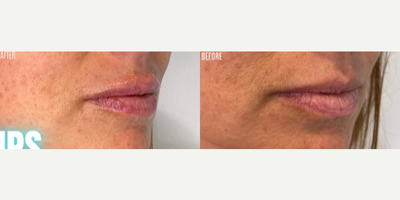 Lip Fillers before and after photo