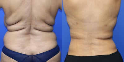 Liposuction before and after photo