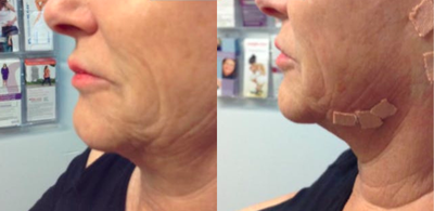 Thread Lift before and after photo