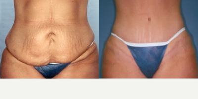 Tummy Tuck before and after photo