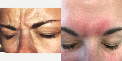 Botox before and after photo