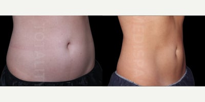 CoolSculpting before and after photo
