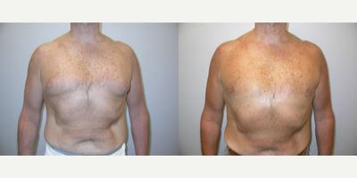 Gynecomastia Surgery before and after photo