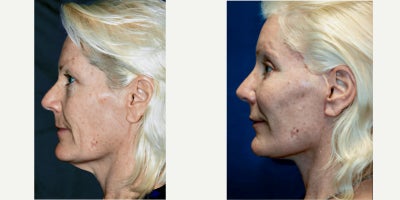 Neck Lift before and after photo