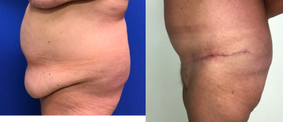 Tummy Tuck before and after photo