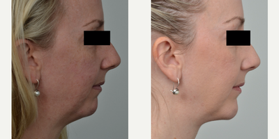 Chin Implant before and after photo
