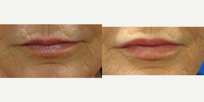 Lip Fillers before and after photo
