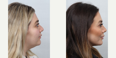 Revision Rhinoplasty before and after photo