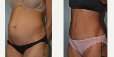 Tummy Tuck before and after photo