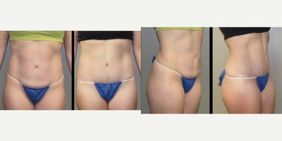 Tummy Tuck before and after photo