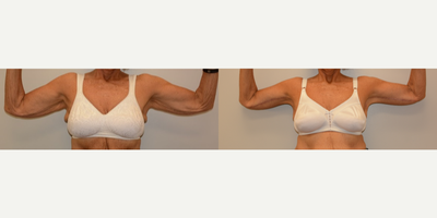 Arm Lift before and after photo