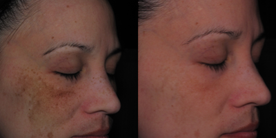 Chemical Peel before and after photo