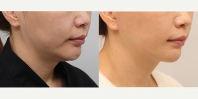 Chin Liposuction before and after photo