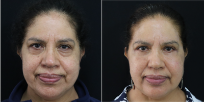 Eyelid Surgery before and after photo