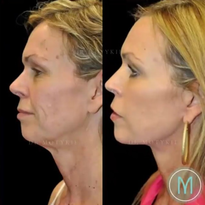 Facelift before and after photo