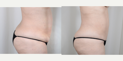 Liposuction before and after photo